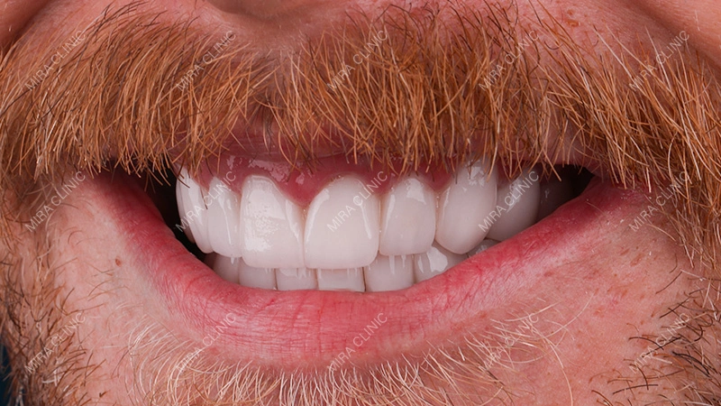 Hollywood Smile
